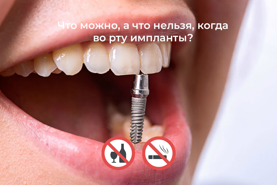 Что можно, а что нельзя делать, когда во рту стоят импланты?