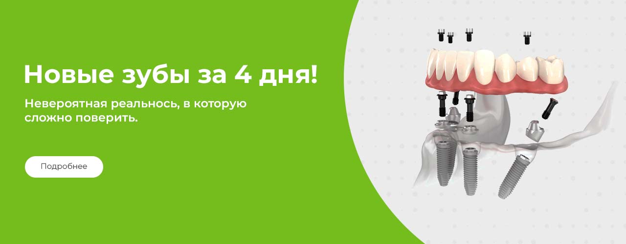 Имплантация all-on-4 в Минске