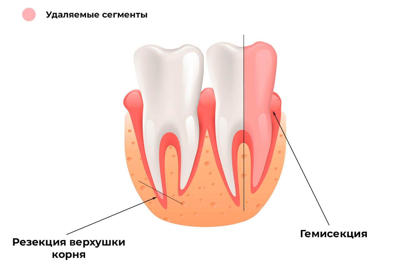 Резекция зуба, гемисекция зуба