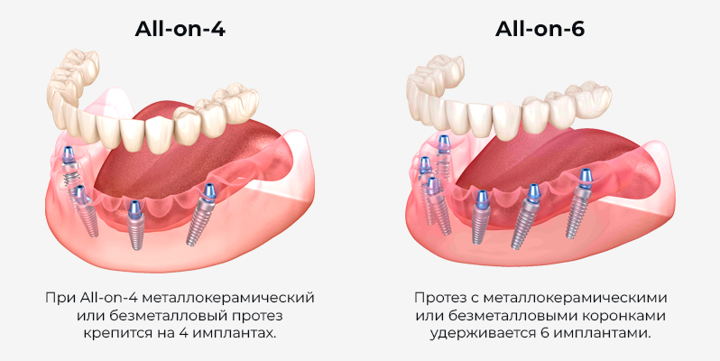 Имплантация All-on-4/6 - как выглядят протезы на 4 и 6 имплантах