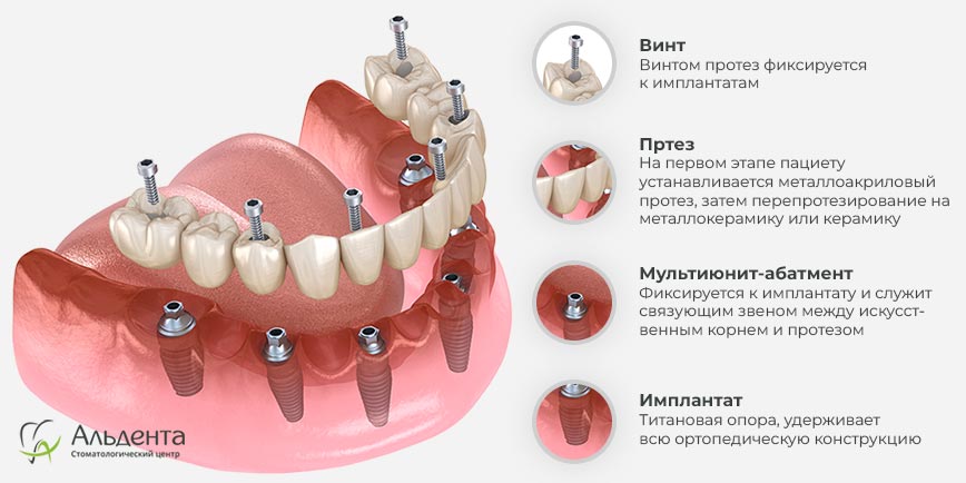 Имплантация All-on-6 Минск цены