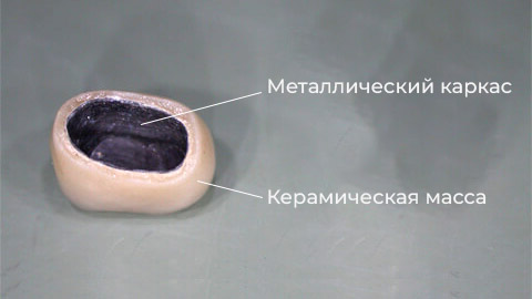 Металлокерамические коронки в Минске