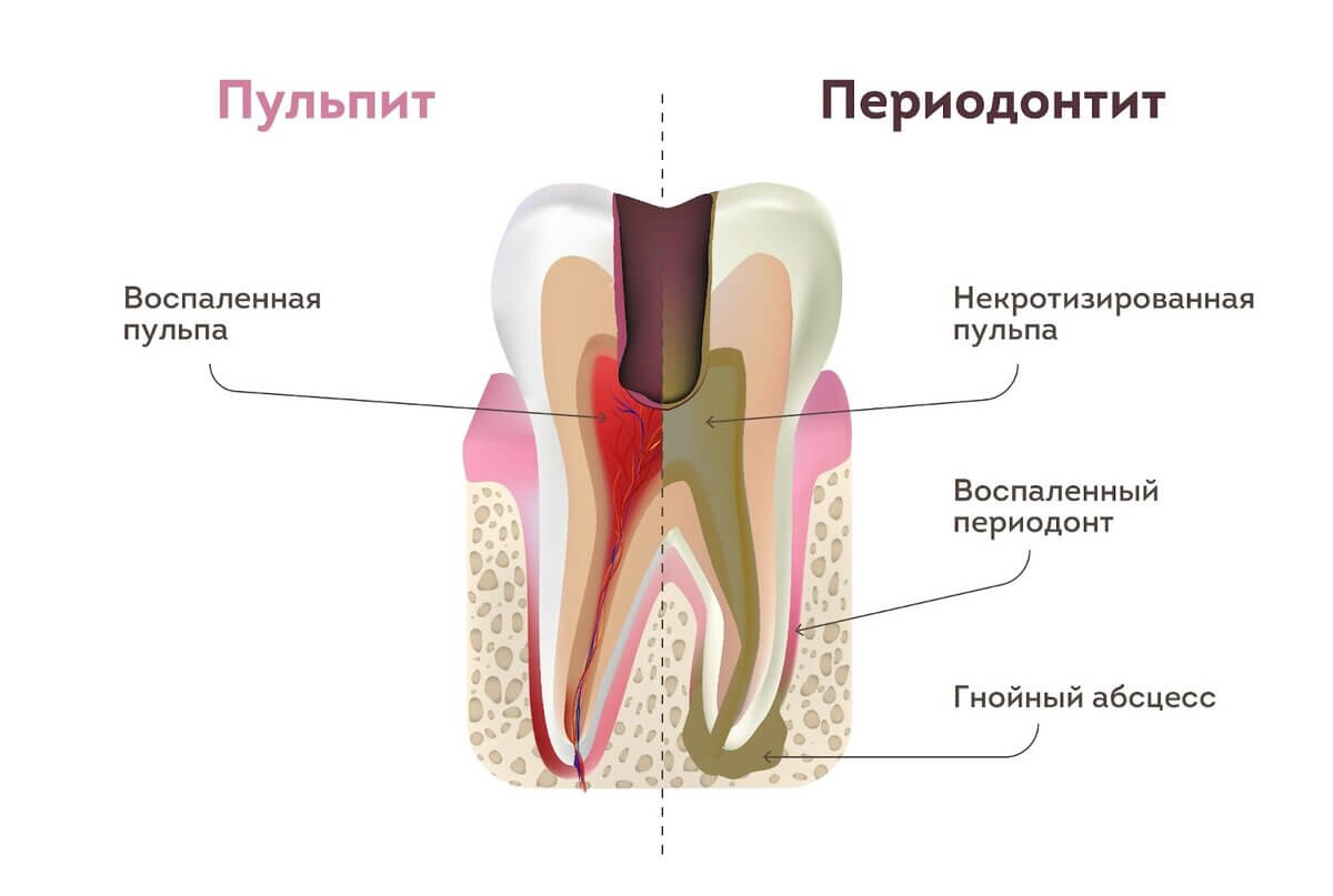 Периодонтит