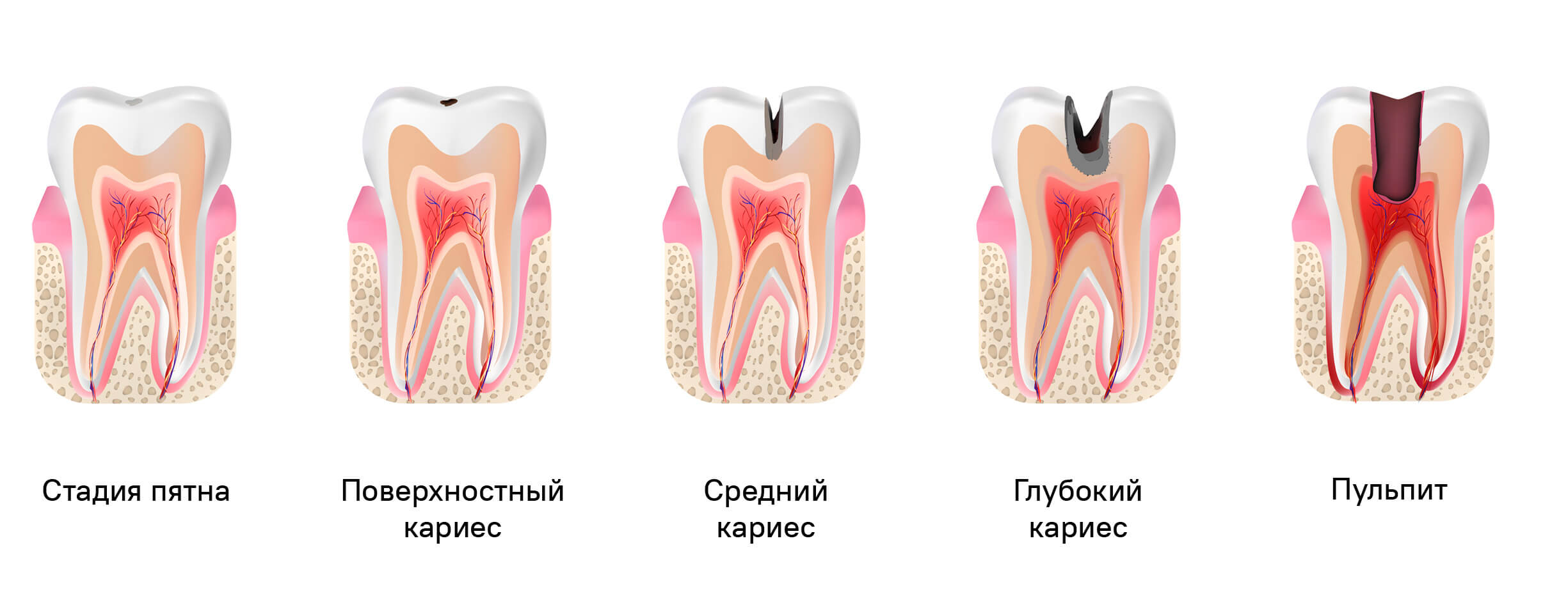Пульпит