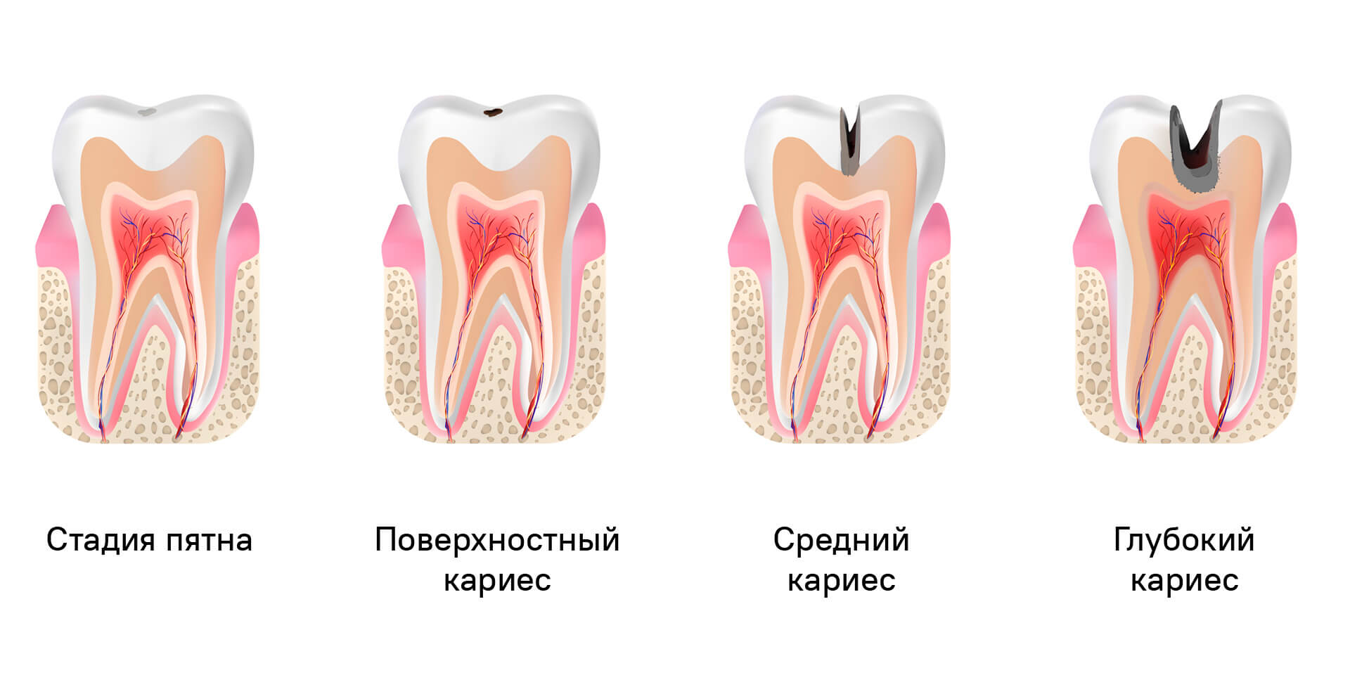 Разновидности кариеса